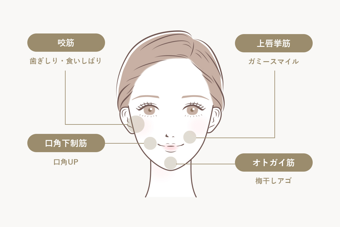 ボトックスを注入できる箇所