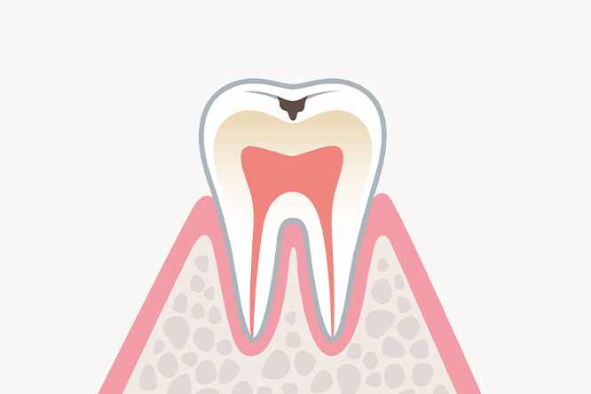C1:エナメル質のむし歯
