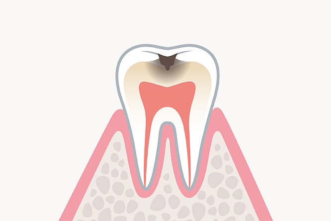 C2:象牙質のむし歯