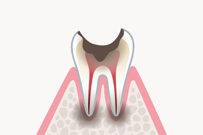C4:歯根に達したむし歯